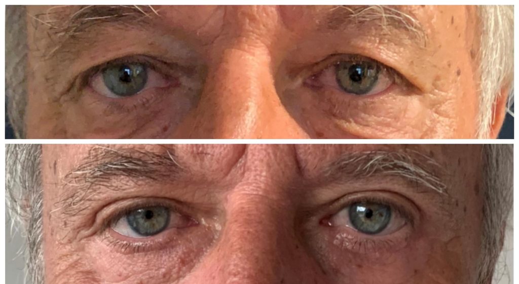 Lidstraffung Plastische Chirurgie, Schönheitschirurg Dr. Paul Pointinger, Wien, Schönheits OP